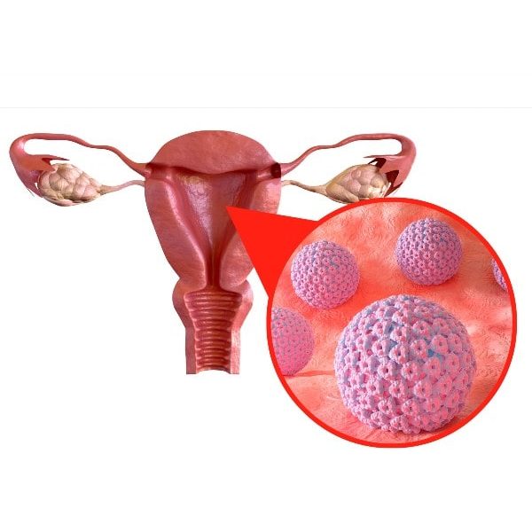 Tratamiento Papiloma Virus en Quito Dr. Ricardo Miranda-min